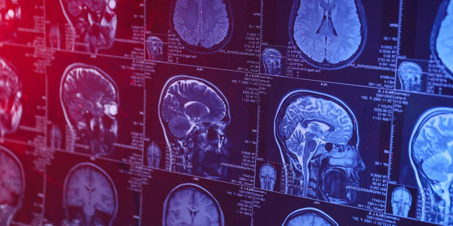 Smartphone Overuse Linked to Gray-Matter Reduction and Brain Connectivity Shifts