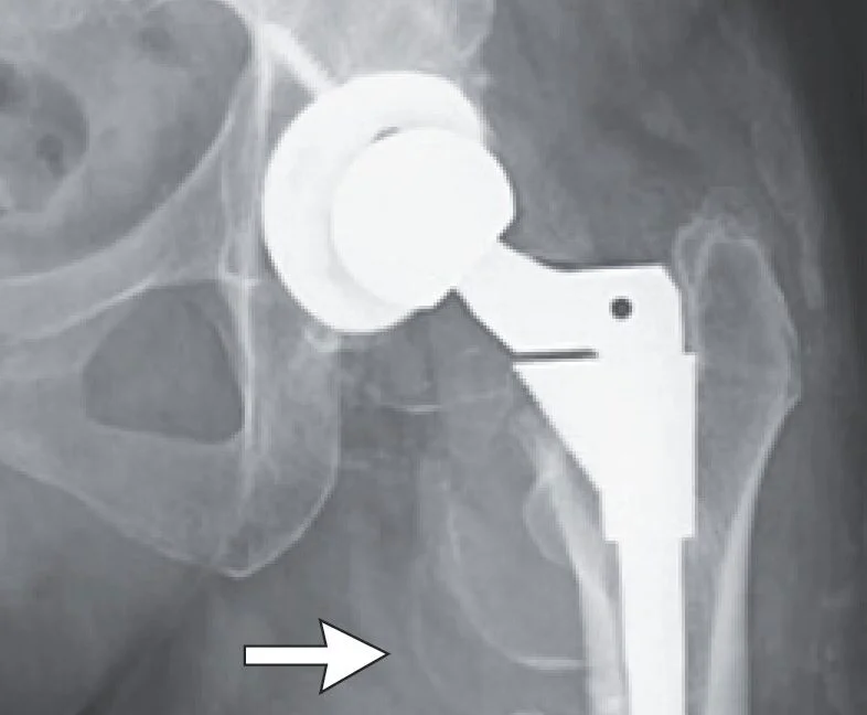 Ceramic hip wear sparks rapid cobalt poisoning and surgical salvage