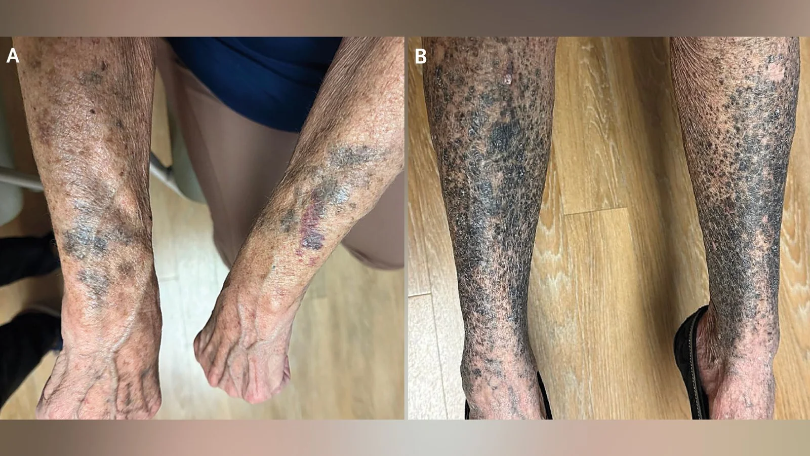 Rosacea antibiotic linked to blue-gray skin patches: a minocycline side effect