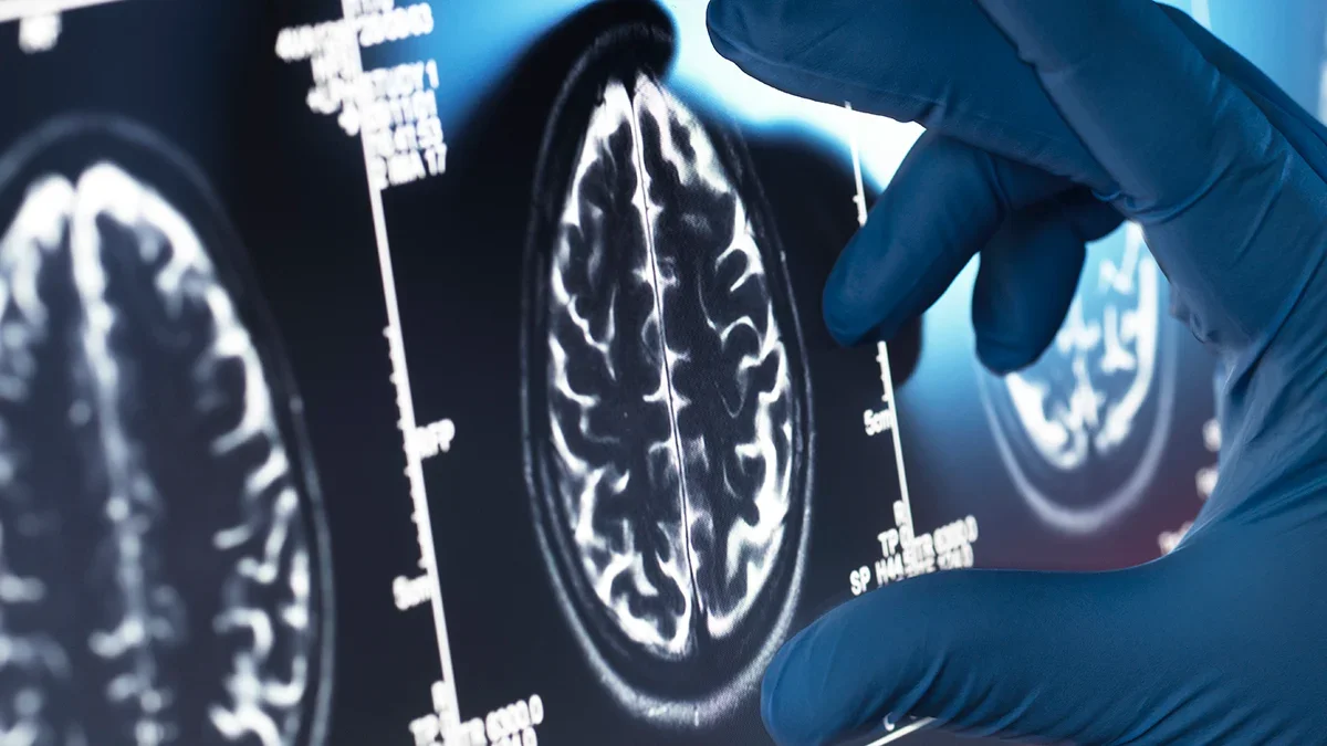 Amyloid-targeting Alzheimer’s drugs fall short on patient benefit, review finds
