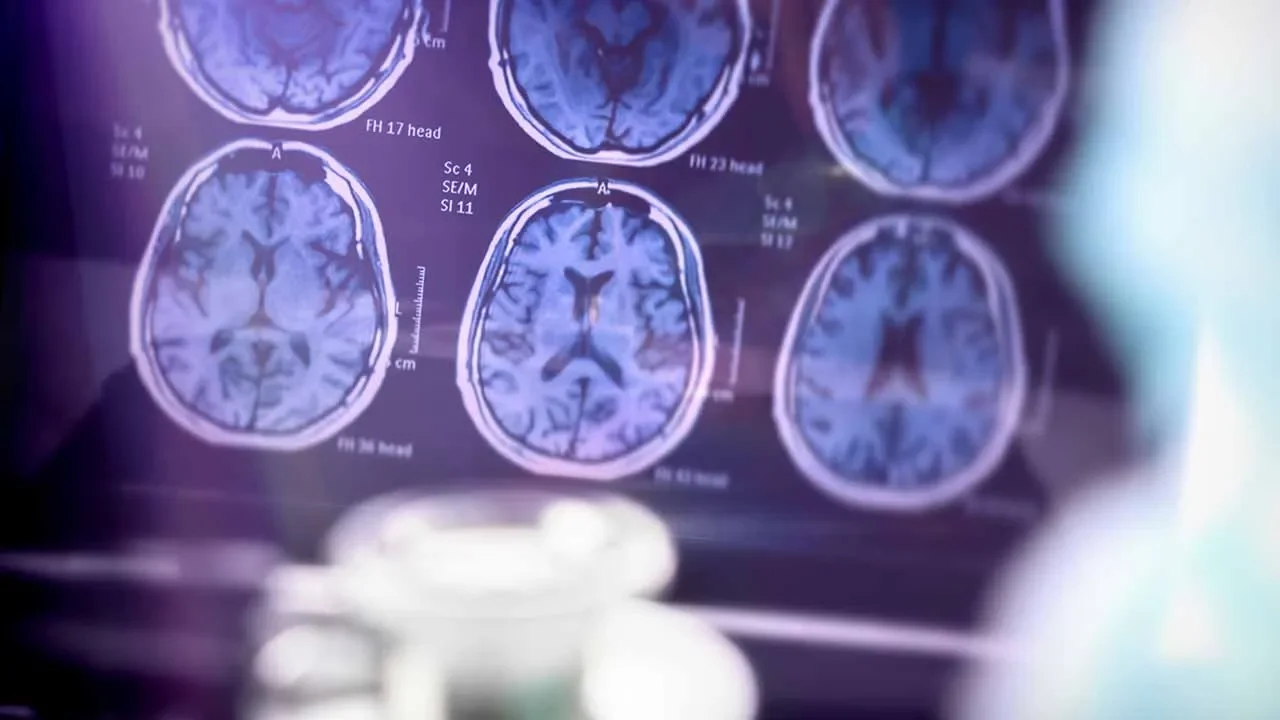 Alzheimer's Prevalence: California Leads in U.S., Southeast and East Most Affected