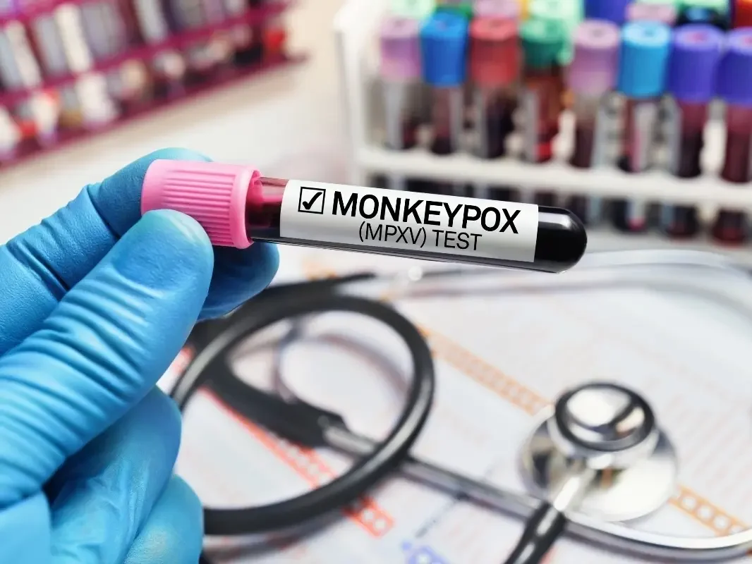 Connecticut Reports First Clade I Mpox Case, Urges Vaccination