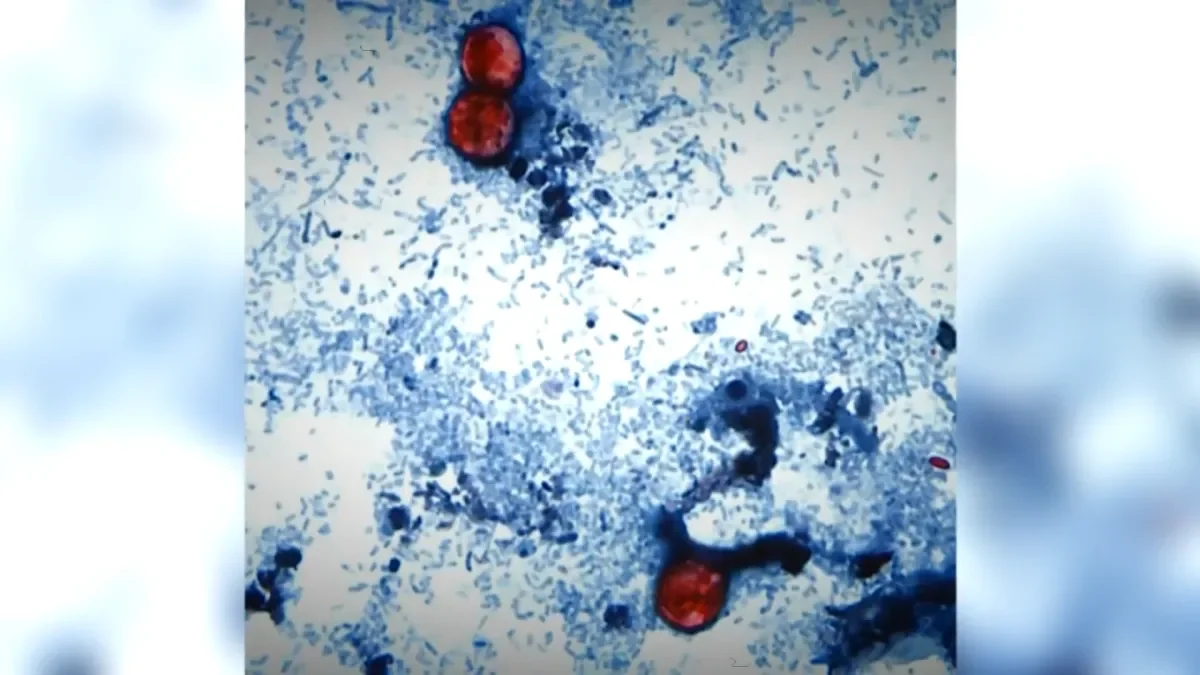 Connecticut logs 35 Cyclospora infections, as investigators probe exposures