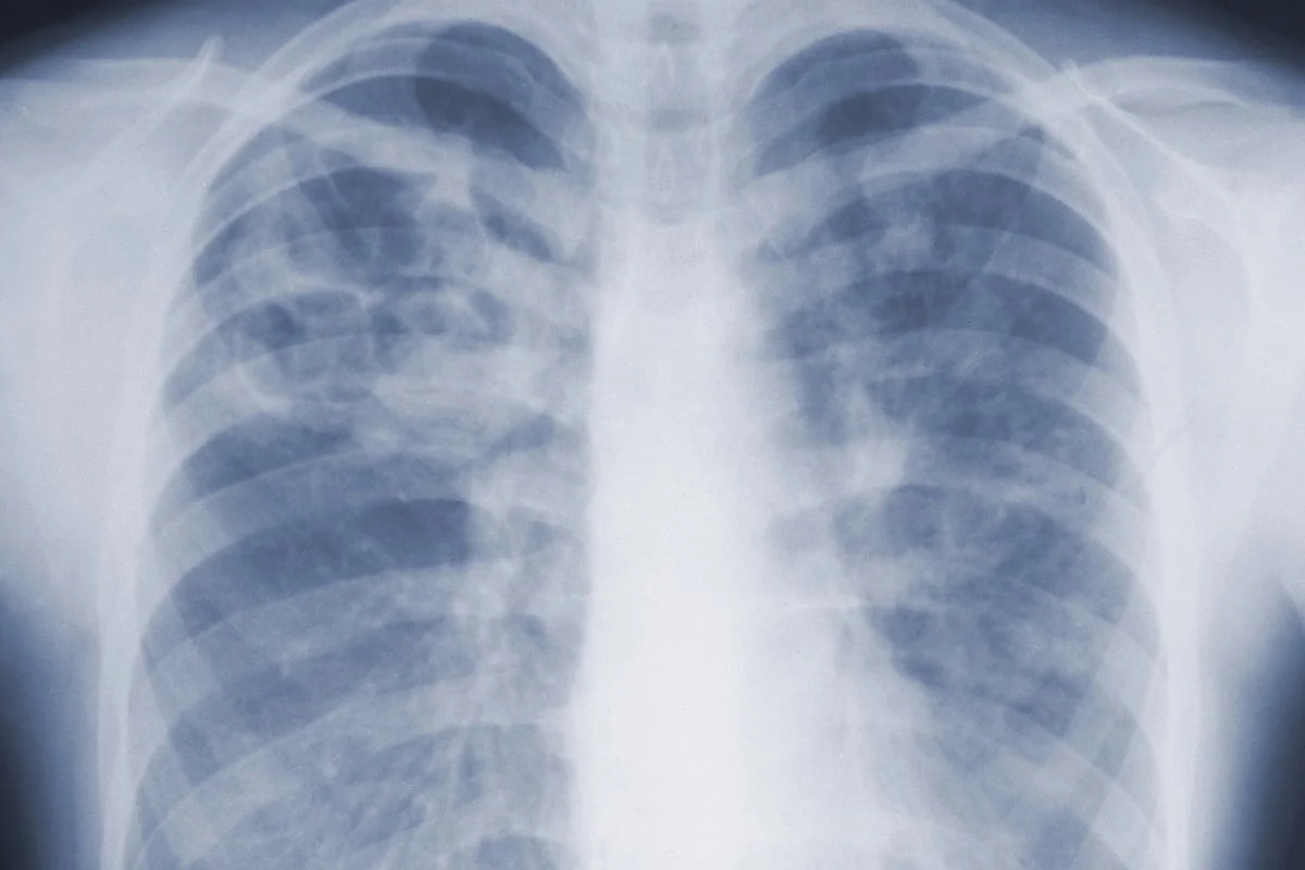 CDC study highlights hidden danger of invasive mold infections in U.S. hospitals