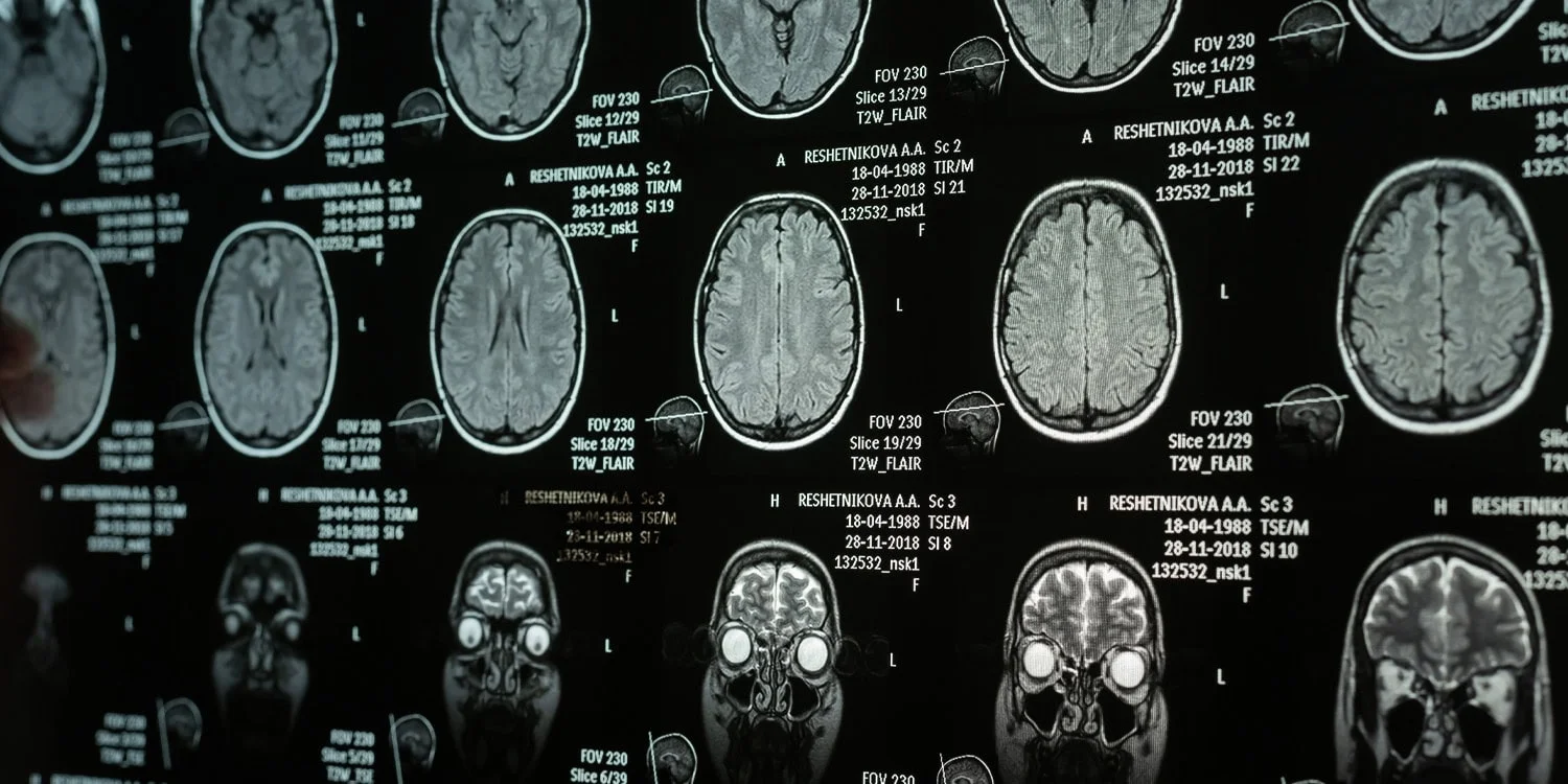 Anterior insula ties narcissistic traits to emotional suppression, study shows