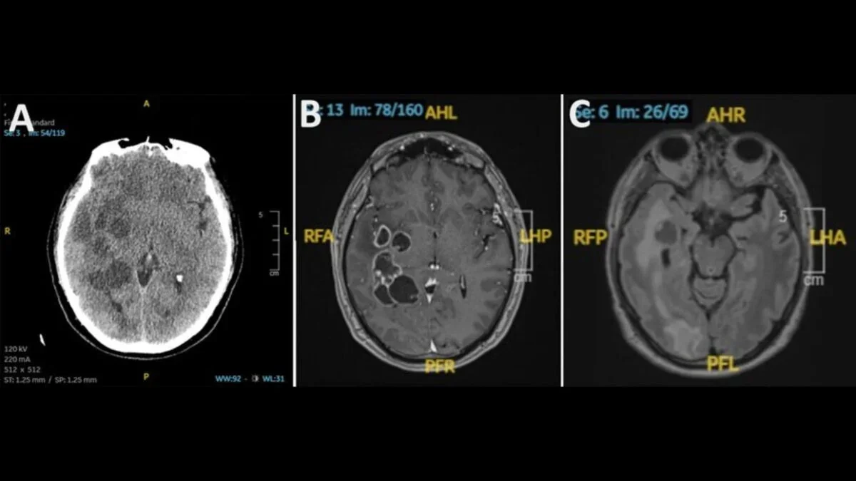 Tapeworm in the Brain Mistaken for Cancer, Case Reveals