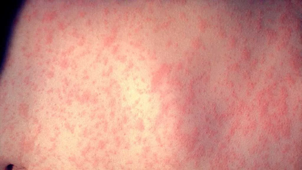 Iowa measles exposure map pinpoints possible contact sites