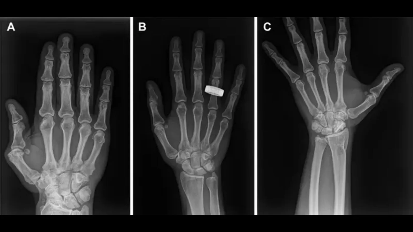 In-orbit X-rays: portable imaging debuts for astronauts and remote clinics