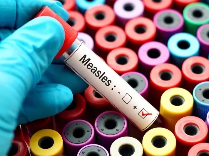 Connecticut Detects First Measles Case of 2026, Unvaccinated Traveler Hospitalized