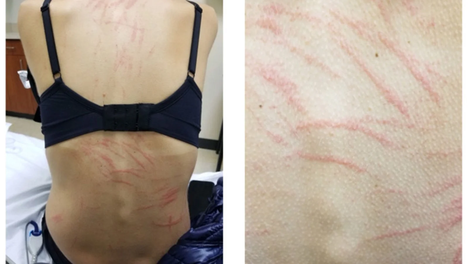 Whip-marked rash after shiitake mushrooms reveals a rare dermatitis case