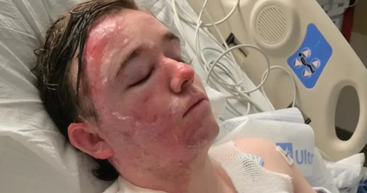 Yuba City McDonald’s worker severely burned after coworker hurls hot oil