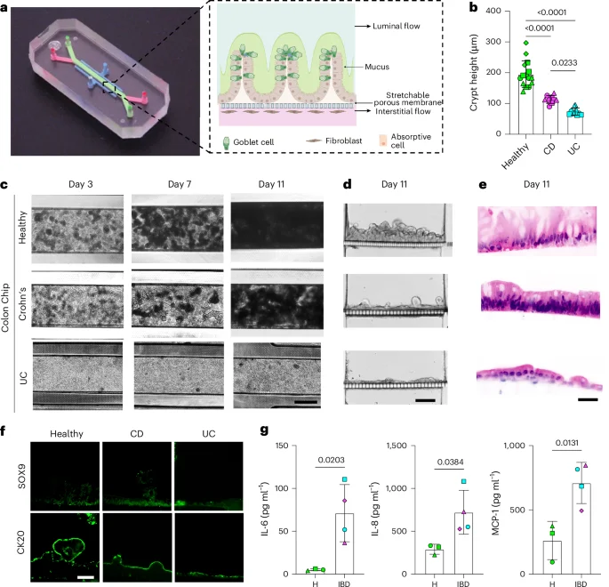 Colon-on-a-chip uncovers stromal drivers, hormonal influences, and cancer risk in IBD