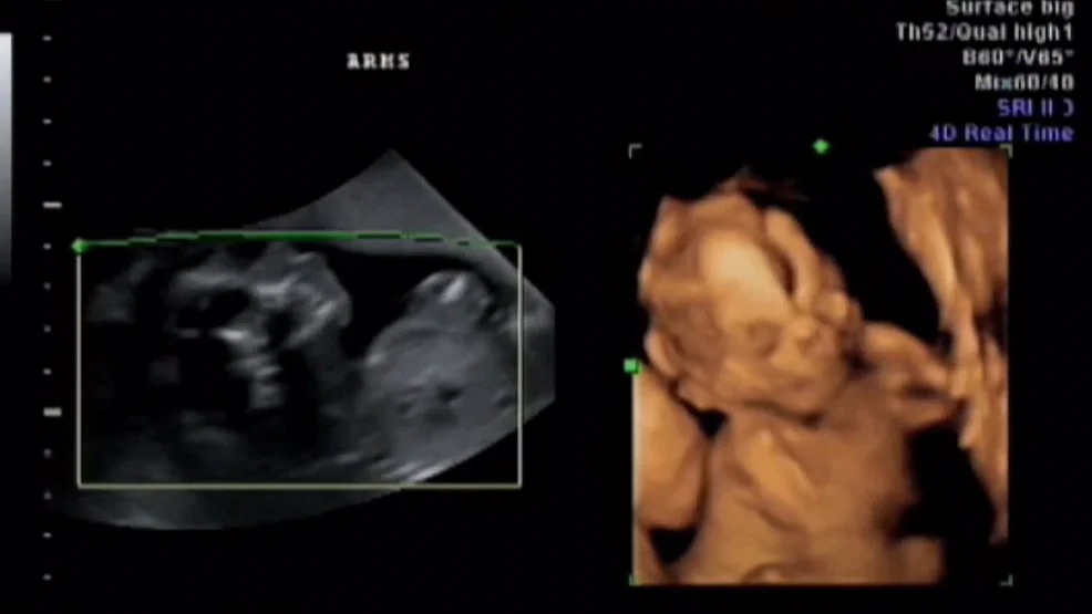 Controversial Abortion Legislation Sweeps Florida Senate