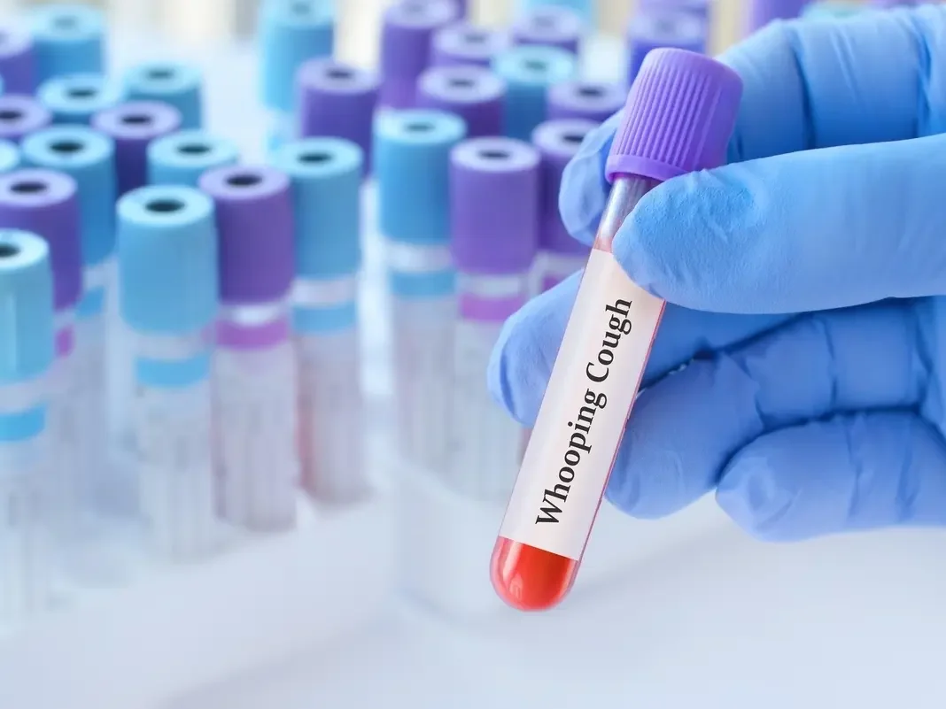 Pasadena Pertussis Outbreak Triggers Public Health Warning