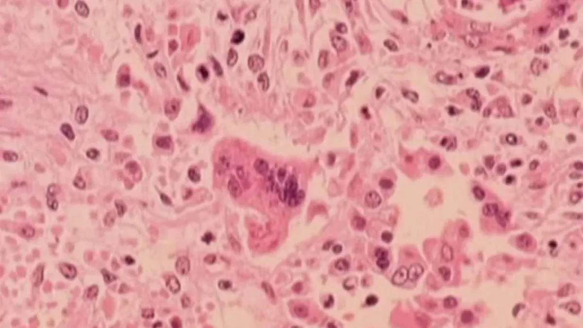 Connecticut Records First Measles Case of 2026, Unvaccinated Traveler Hospitalized