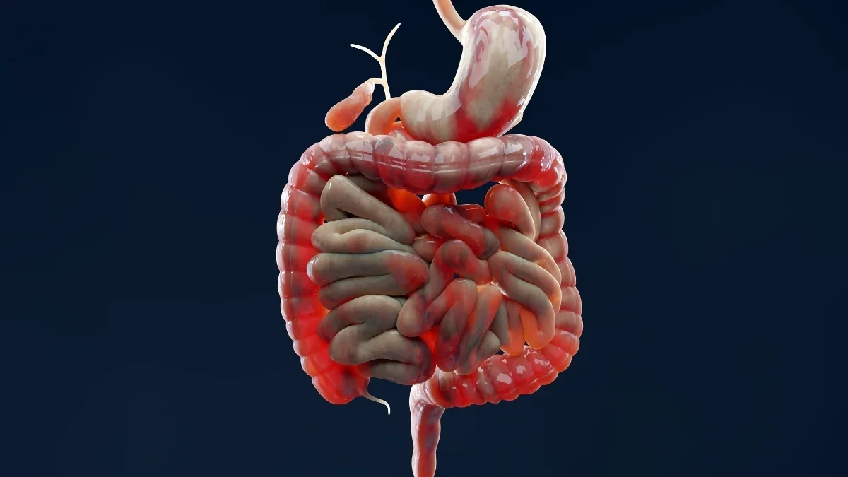 Genetic Variant Tied to IBD Drives Disease via IL-10–Neutralizing Antibodies