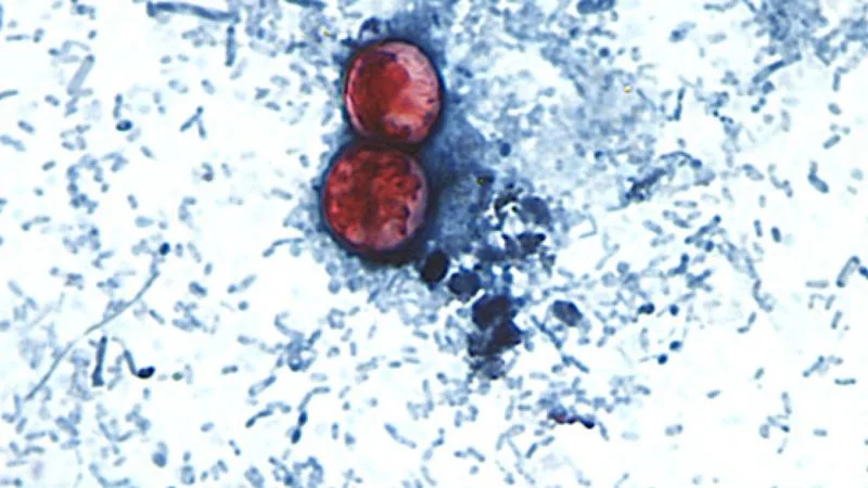 Surge in cyclosporiasis linked to raw produce hits several states