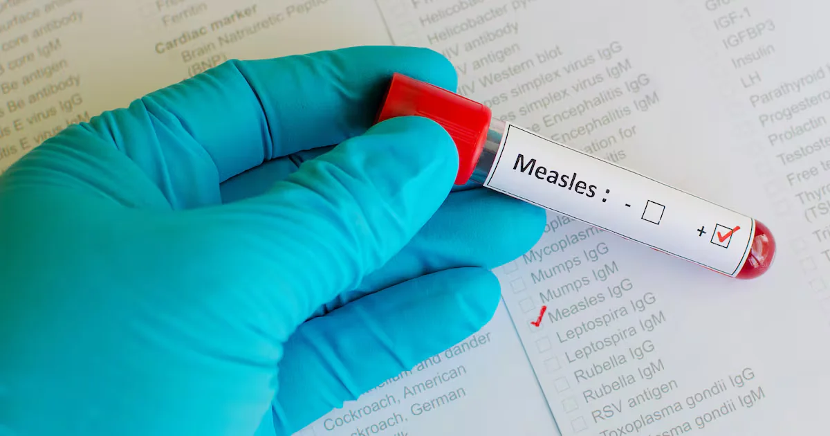 Three unvaccinated metro Atlanta residents contract measles after international travel