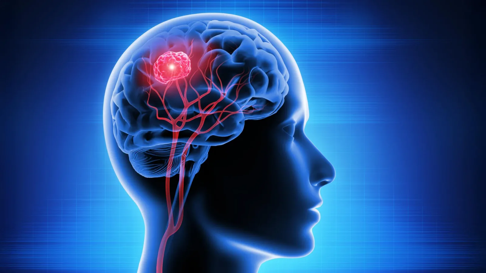 Vitamin B12–Derived Therapy Penetrates Brain Barrier to Target Glioblastoma