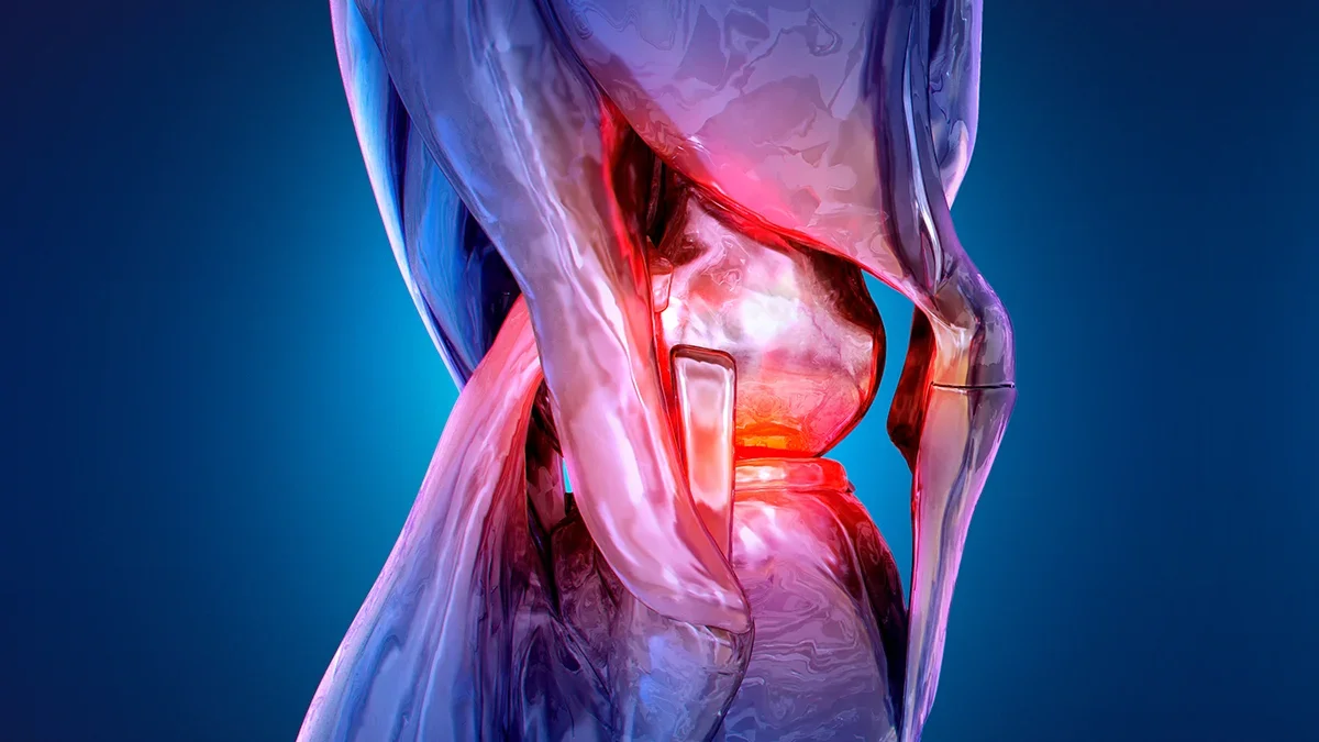 New Knee OA Therapy Halves Pain Over a Year Without Surgery