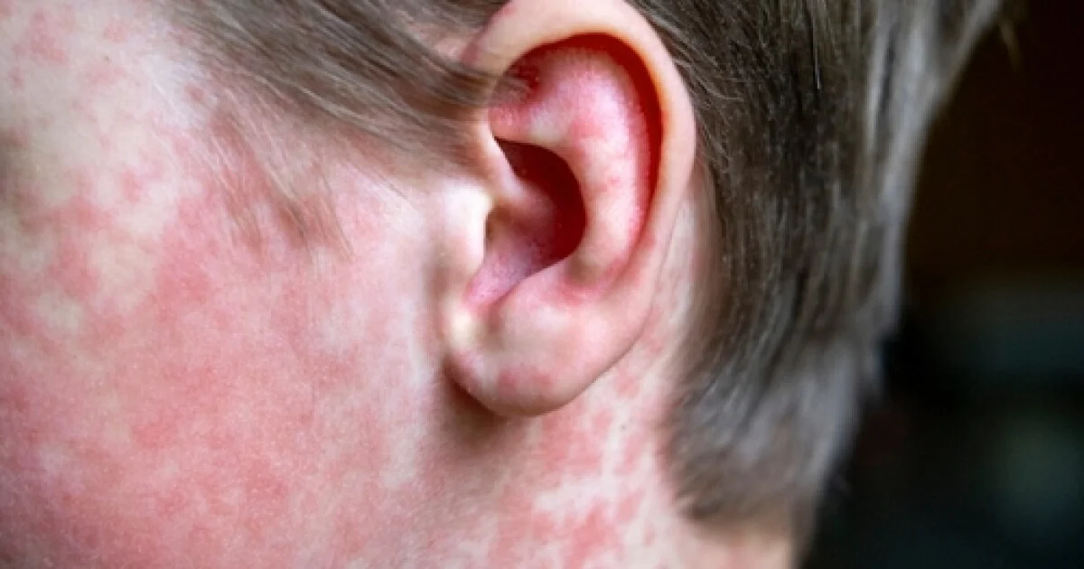 Measles exposure triggers public health alert in Queen Creek with three exposure sites