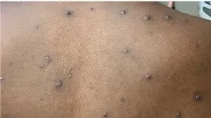 Arizona reports first case of deadlier mpox strain contracted abroad