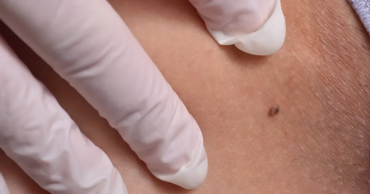 Mole Check 101: ABCDE Signs That Could Signal Skin Cancer
