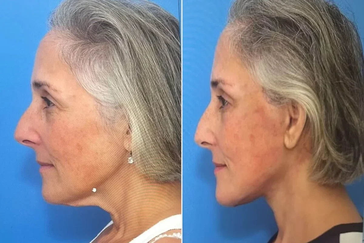 Ricki Lake Reflects on 2-Year Facelift with Fresh Before-and-After Photos