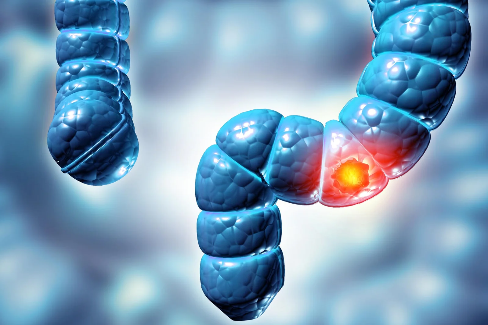 Researchers uncover hidden gut virus tied to colorectal cancer