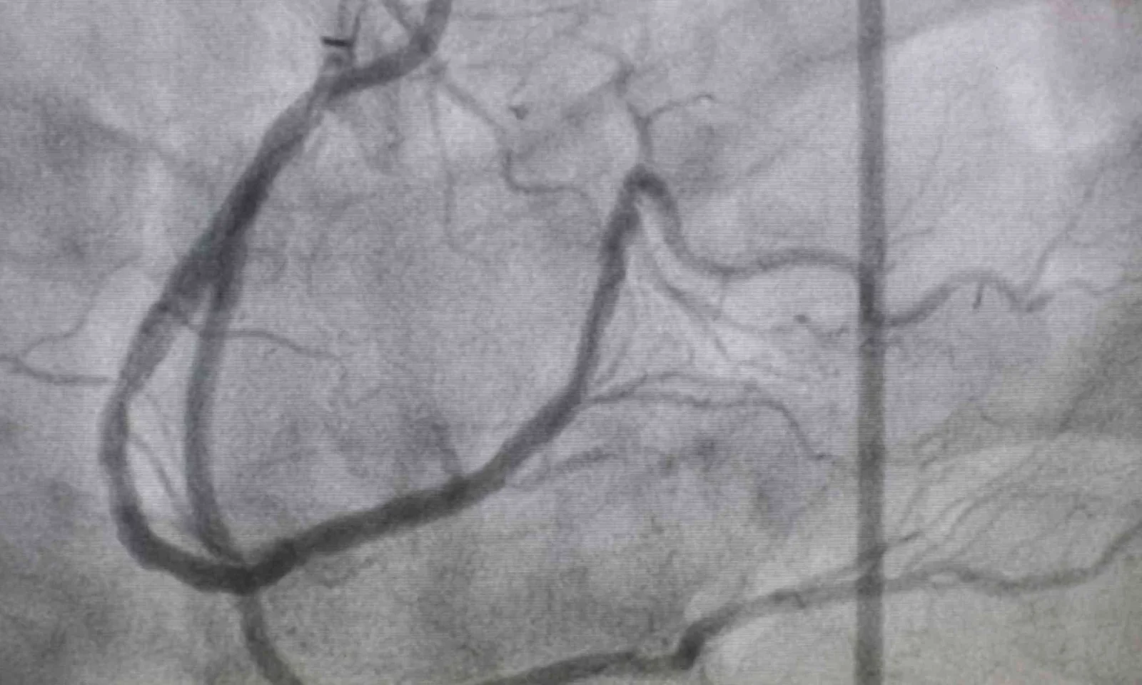 Post-thrombectomy drug enhances stroke recovery by clearing downstream brain vessels