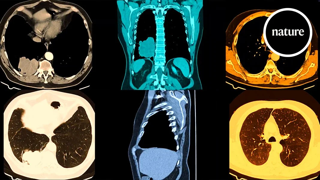 Intercepting Lung Cancer: Could a Pill Stop It Before It Starts?
