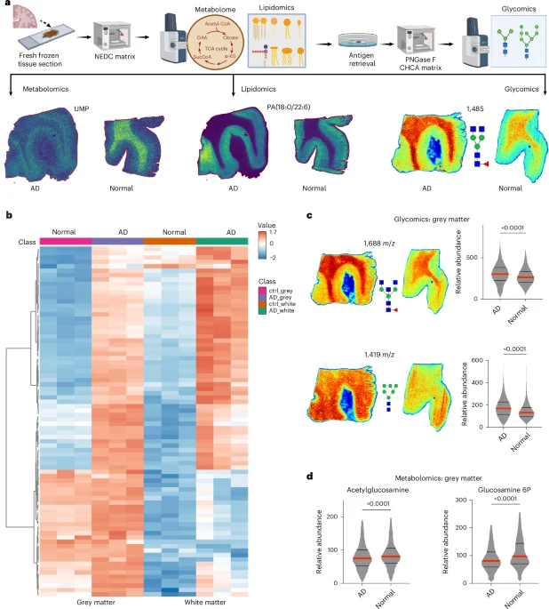 Hyperglycosylation fuels Alzheimer's progression, revealing a new therapeutic target
