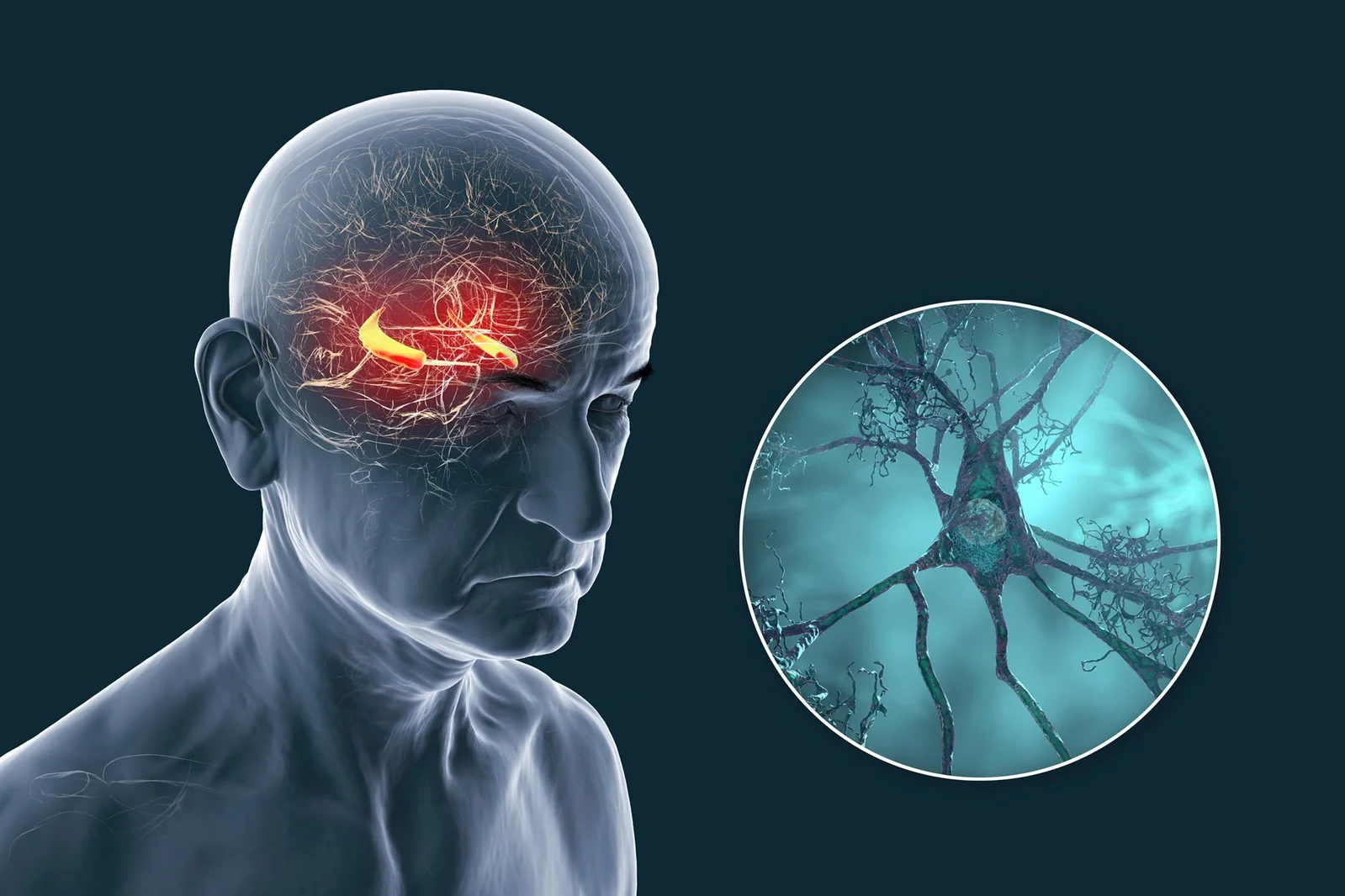Intracellular Tug-of-War Between Amyloid Beta and Tau Redefines Alzheimer's Cause