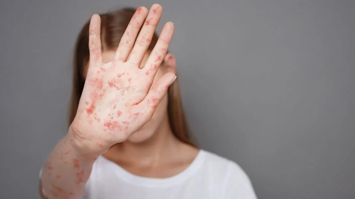 Measles Outbreak Peaks in Minnesota with 18 Cases in 2025
