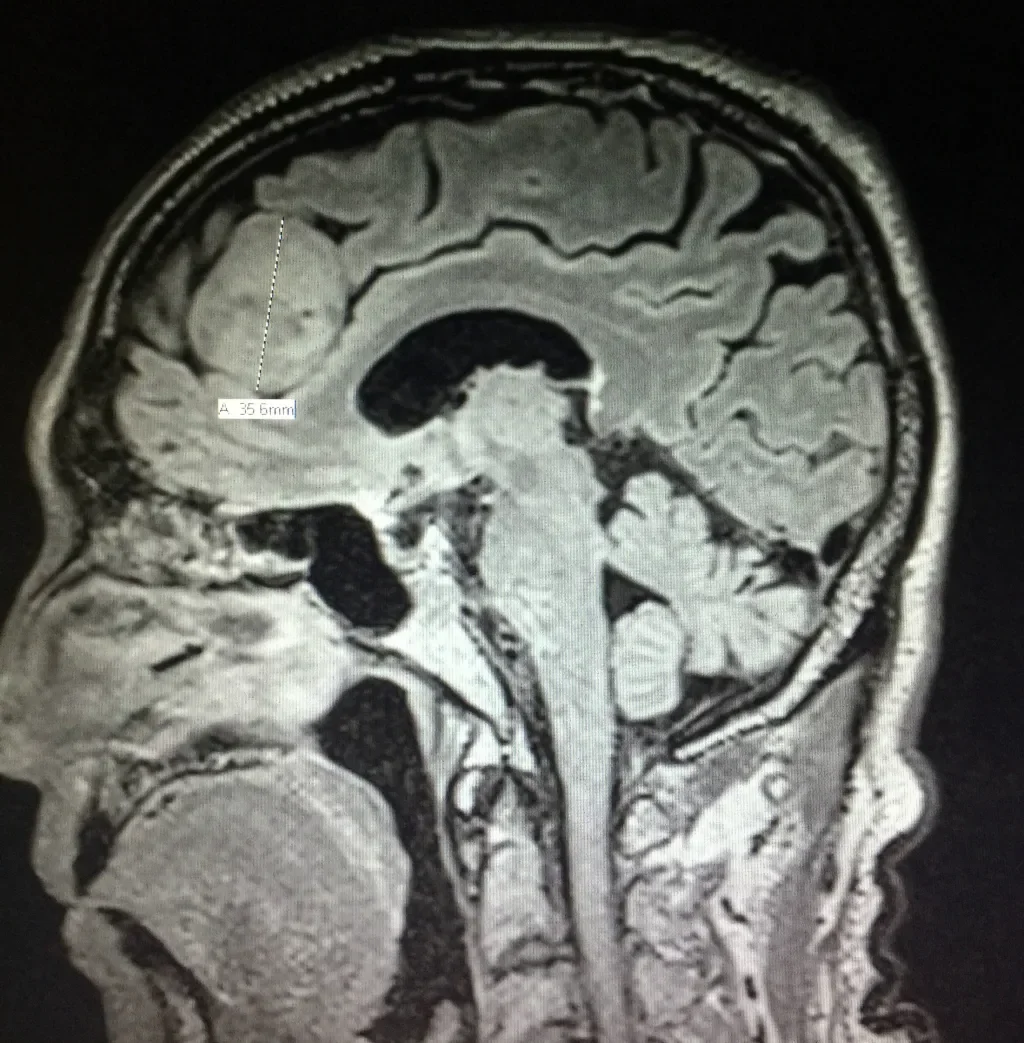 Independent Review Finds No Brain-Tumor Cluster at Newton-Wellesley Hospital