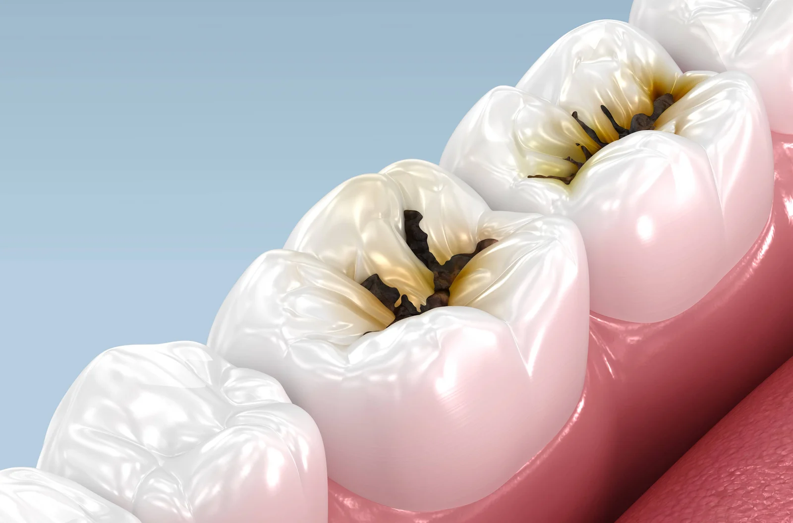 Cheap Liquid Halts Kids’ Cavities Without Drilling, US Trial Finds