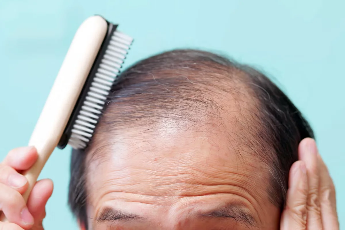 Hair-loss risk linked to GLP-1 weight-loss drugs in large study