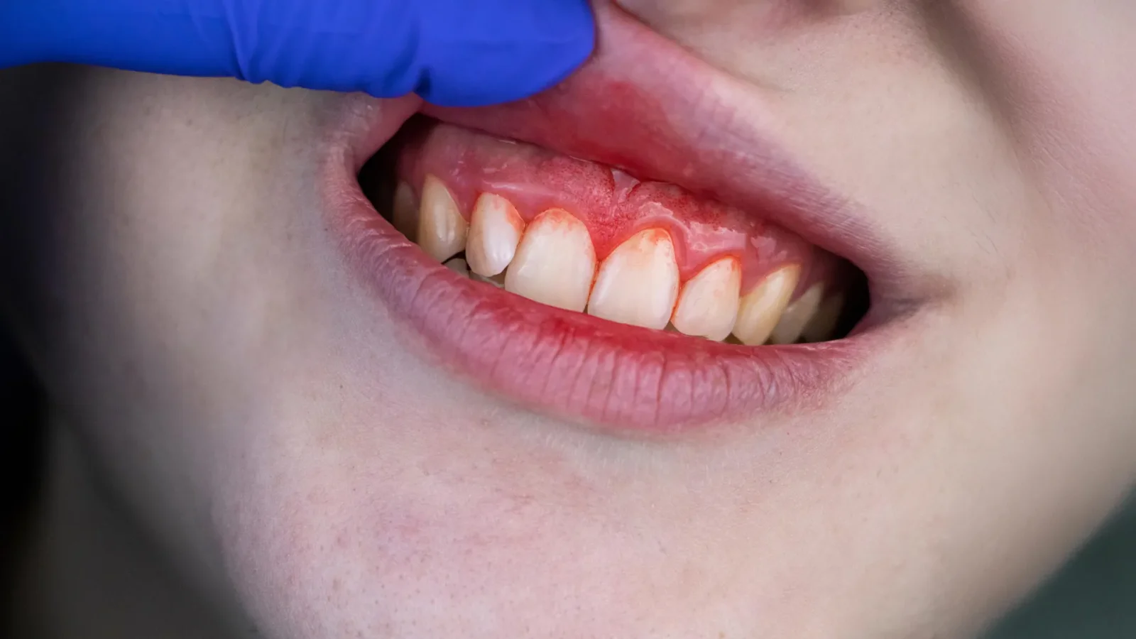 Gum-Disease Bacteria May Drive Calcified Heart Valve Damage, New Research Finds
