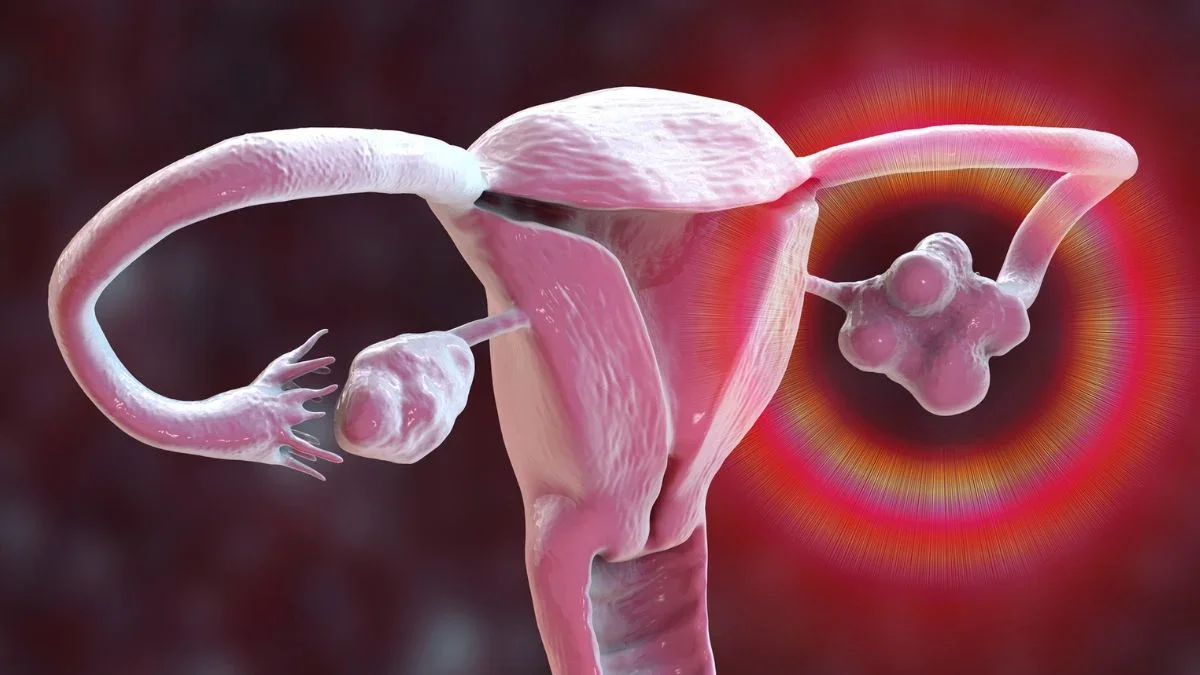 PCOS Gets a Fresh Identity: PMOS Aims to Reflect Multisystem Roots