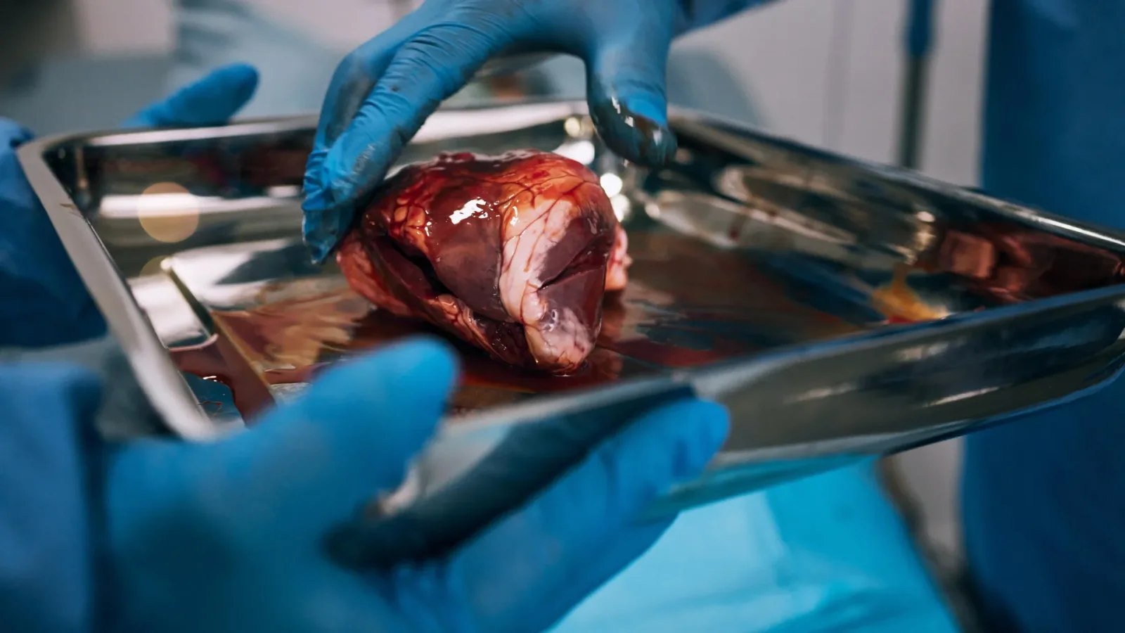 Pre-Waitlist Barriers Block Half of Kidney Transplant Candidates