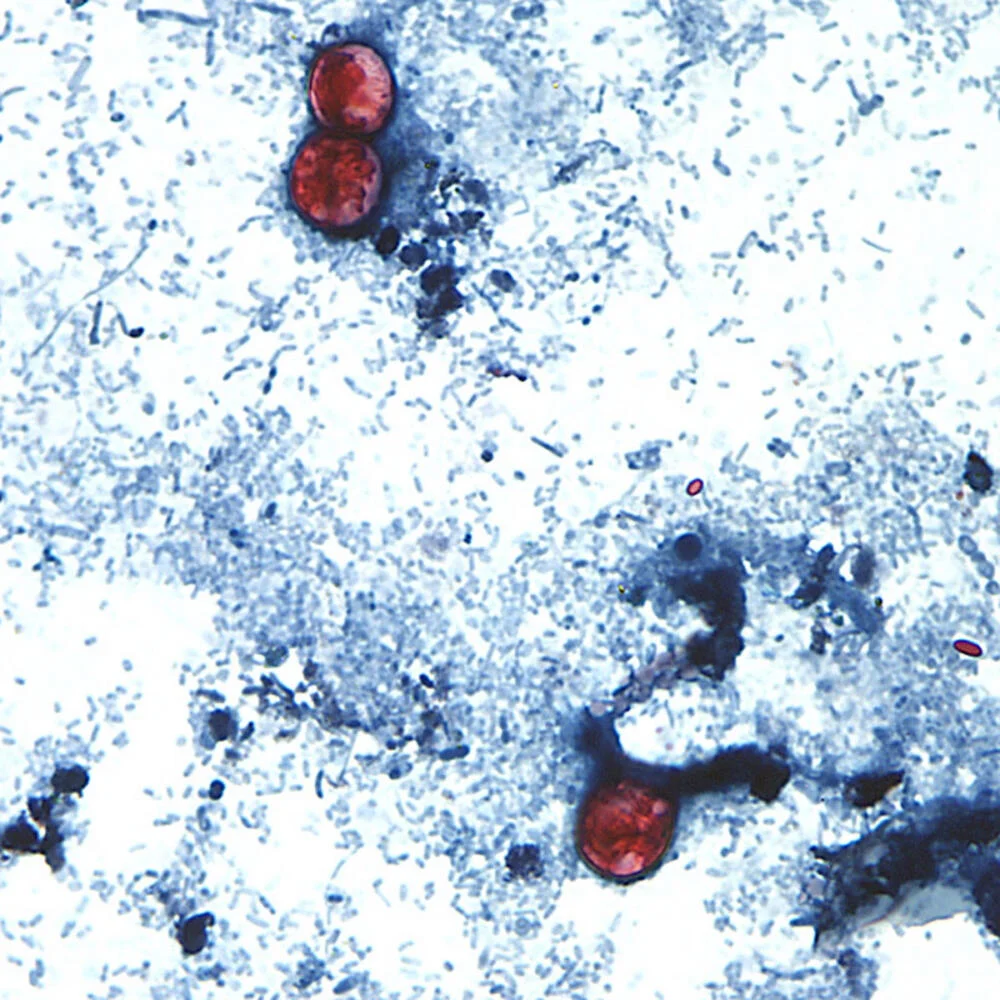 Massachusetts Faces Cyclospora: Key Facts on a Foodborne Parasite