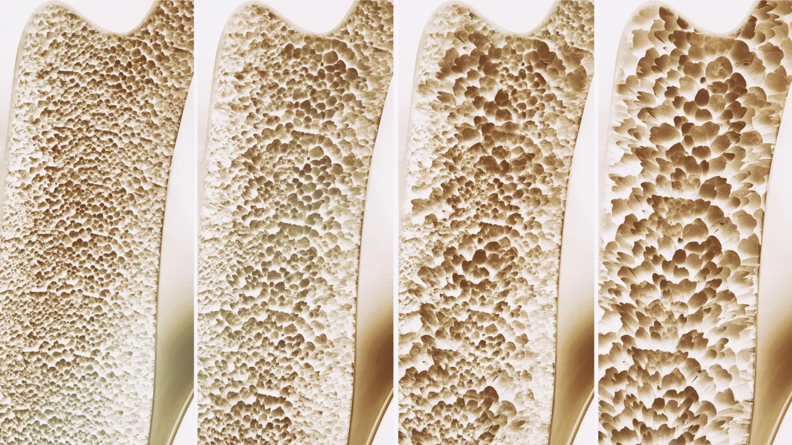Large Review Finds Calcium and Vitamin D Supplements Do Not Significantly Prevent Falls or Fractures