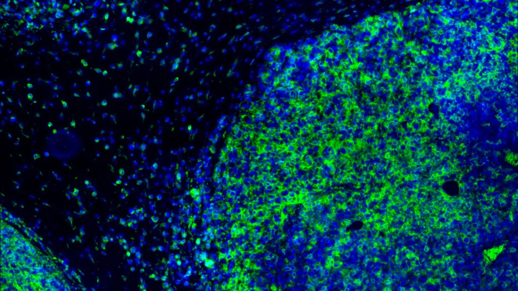 OX40 immunotherapy shows responses in head and neck cancer, strongest in HPV-positive tumors