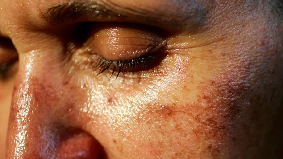 TikTok's illegal tanning drug Melanotan II sparks melanoma and erection risks