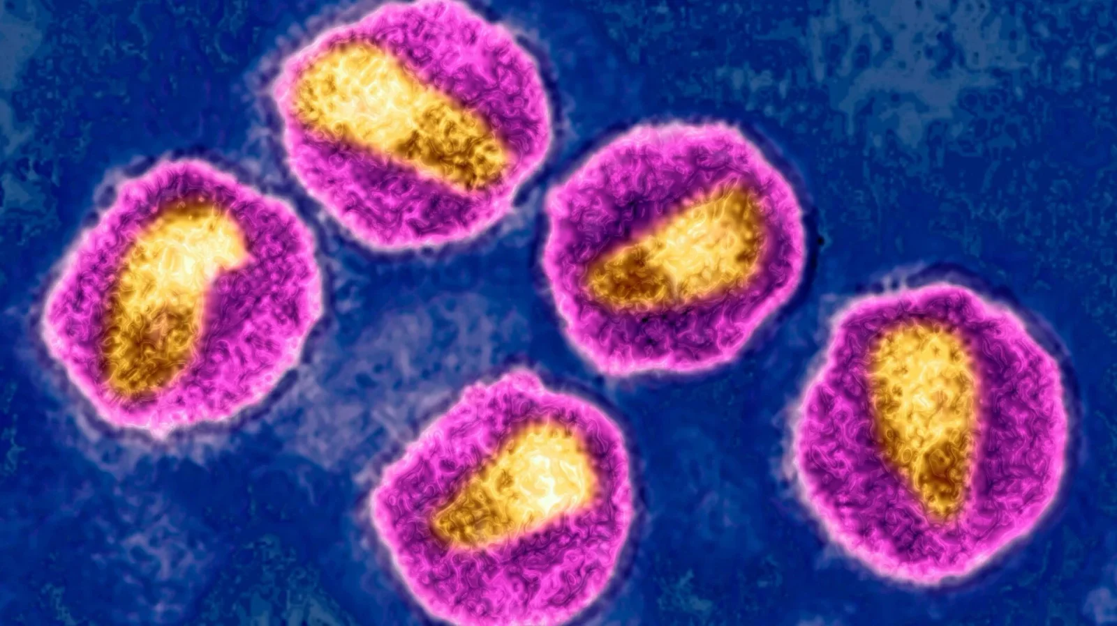 Norwegian HIV Patient Cured via Brother's CCR5-Delta32 Stem Cells
