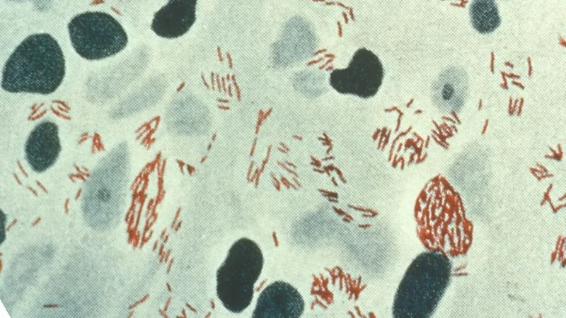 Leprosy Resurgence in Central Florida Raises Public Health Concerns