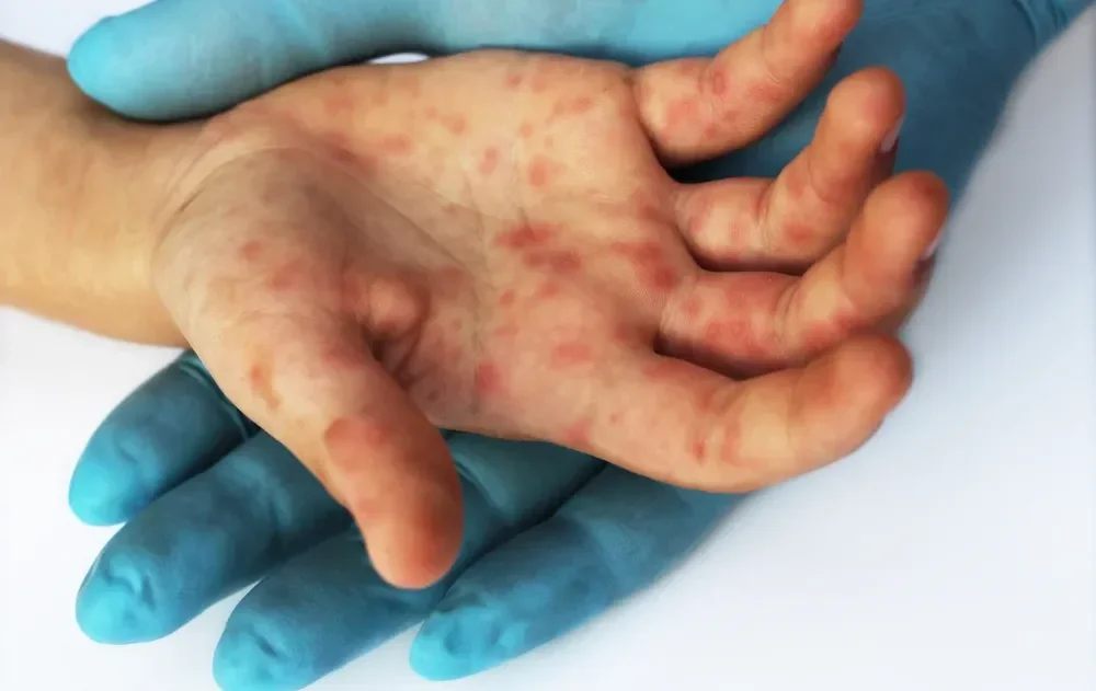 Measles Deaths Rise Amid Vaccine Hesitancy in Ultra-Orthodox Communities
