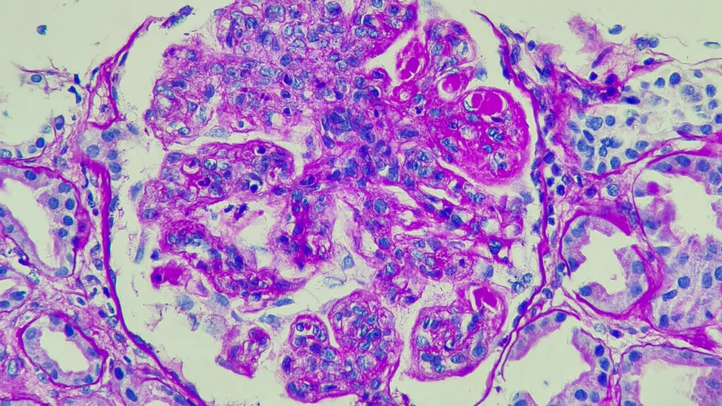 New CAR-T dawn for autoimmune disease: lupus case fuels research and investment