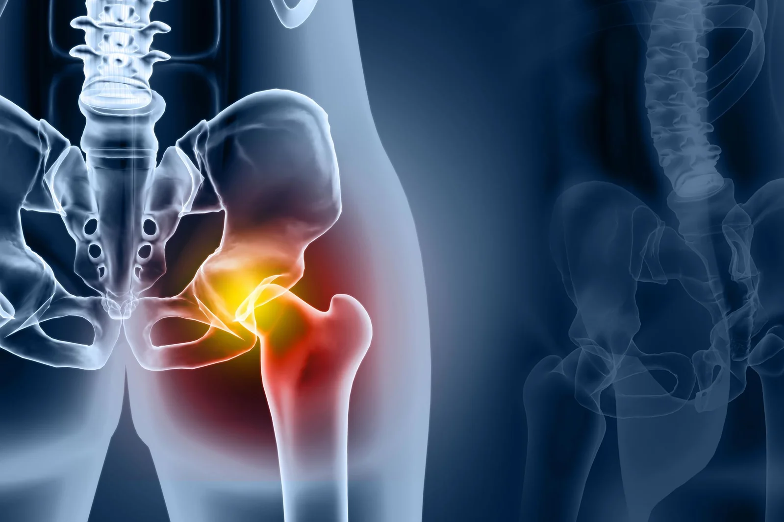 Modern Hip Replacements Deliver Decades of Movement, Study Finds