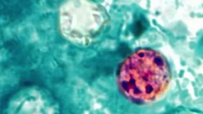 Michigan Faces Largest Cyclosporiasis Spike Yet as Source Eludes Officials